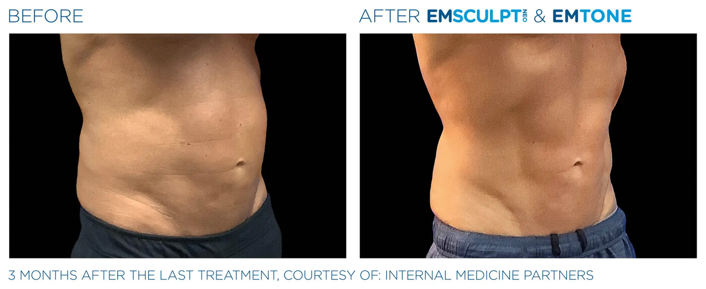 Bayou Bariatrics, Monroe, LA and Weight Loss Clinic - Emsculpt Neo Results