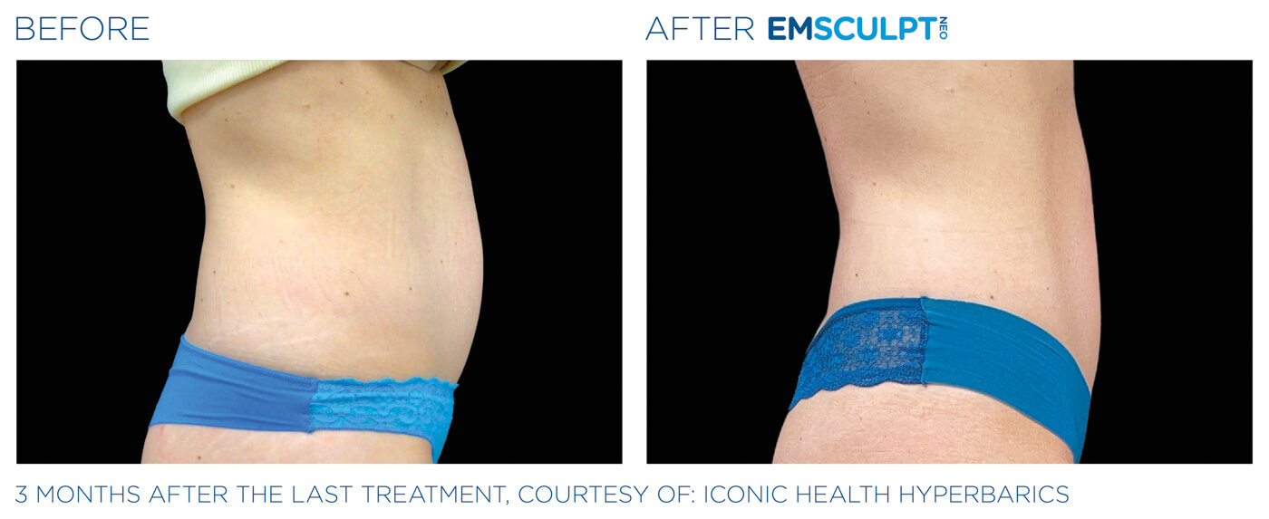 Bayou Bariatrics, Monroe, LA and Weight Loss Clinic - Emsculpt Neo Results