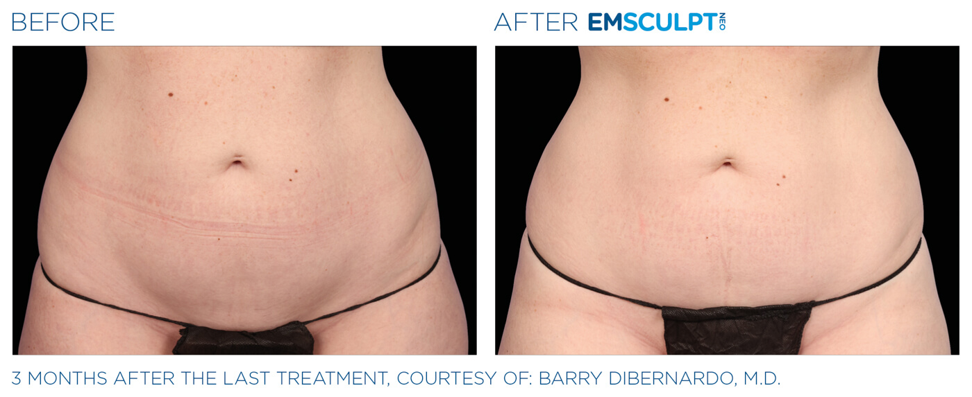 Bayou Bariatrics, Monroe, LA and Weight Loss Clinic - Emsculpt Neo Results