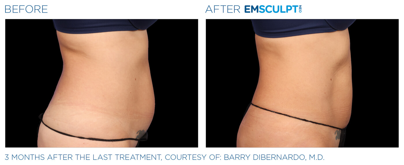 Bayou Bariatrics, Monroe, La and Weight Loss Clinic - Emsculpt Neo Results