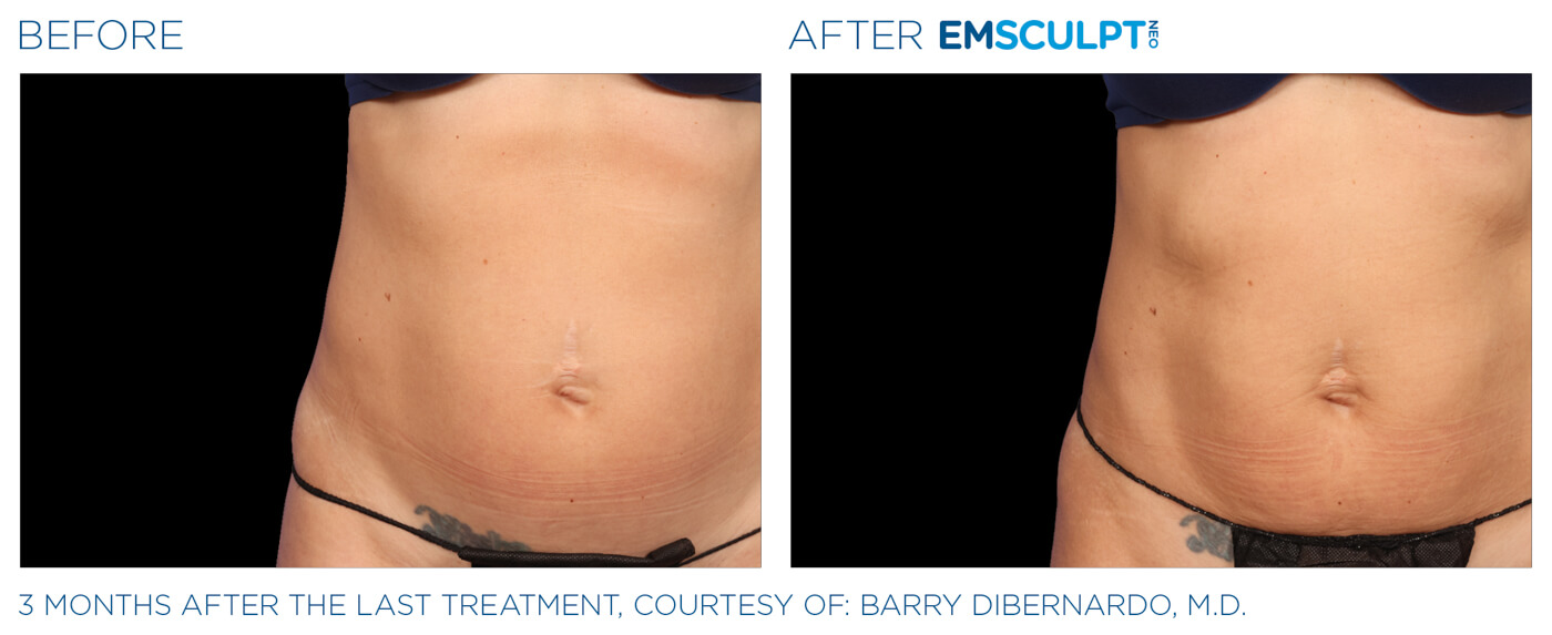 Bayou Bariatrics, Monroe, LA and Weight Loss Clinic - Emsculpt Neo Results