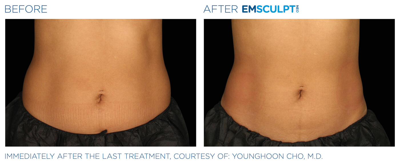 Bayou Bariatrics, Monroe, LA and Weight Loss Clinic - Emsculpt Neo Results