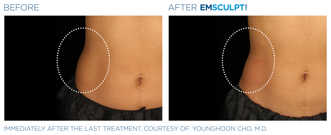 Bayou Bariatrics, Monroe, LA and Weight Loss Clinic - Emsculpt Neo Results