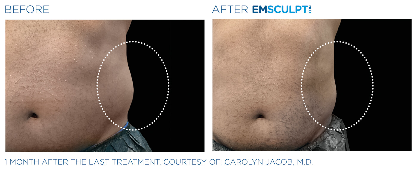 Bayou Bariatrics, Monroe, LA and Weight Loss Clinic - Emsculpt Neo Results