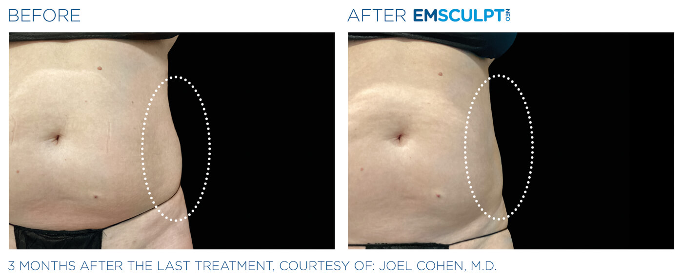 Bayou Bariatrics and Weight Loss Clinic - Emsculpt Neo Results