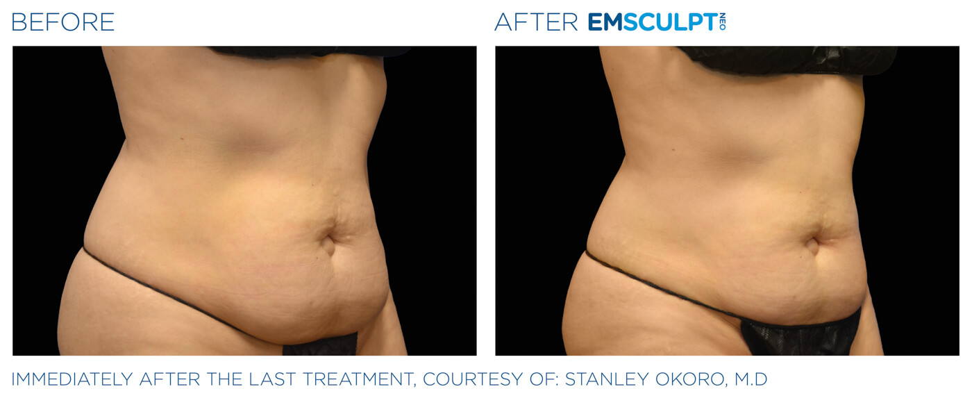 Bayou Bariatrics, Monroe, LA and Weight Loss Clinic - Emsculpt Neo Results