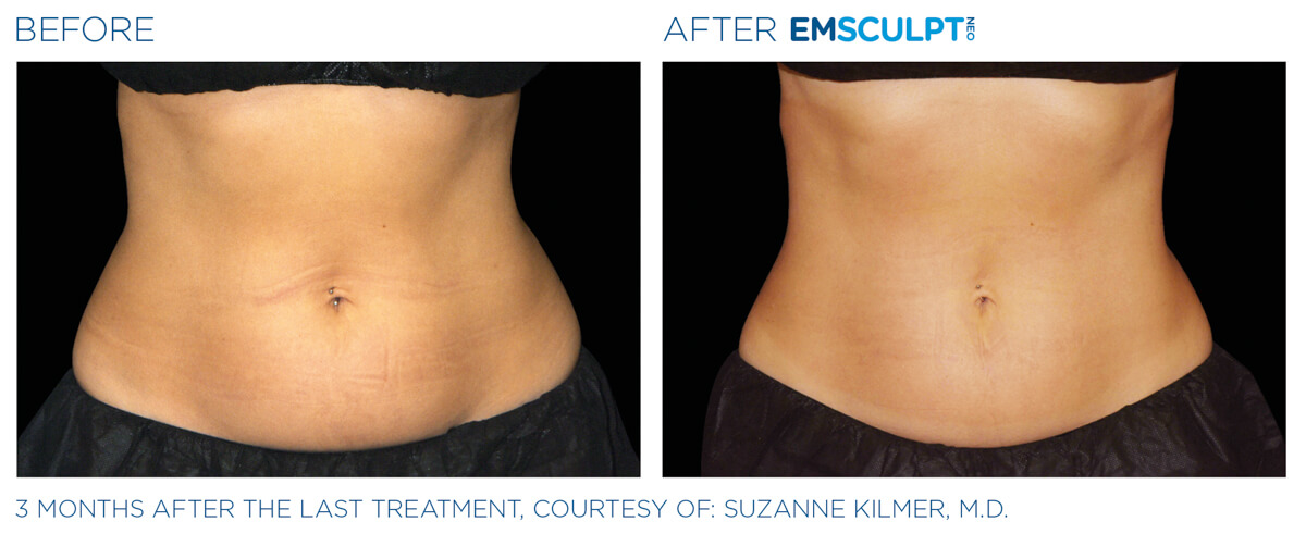 Bayou Bariatrics, Monroe, LA and Weight Loss Clinic - Emsculpt Neo Results