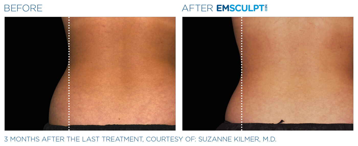 Bayou Bariatrics, Monroe, LA and Weight Loss Clinic - Emsculpt Neo Results