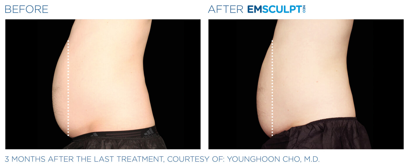 Bayou Bariatrics, Monroe, LA and Weight Loss Clinic - Emsculpt Neo Results