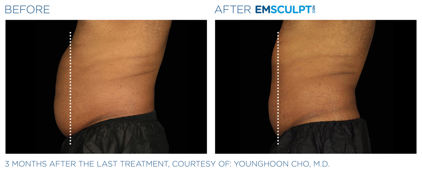 Bayou Bariatrics, Monroe, LA and Weight Loss Clinic - Emsculpt Neo Results