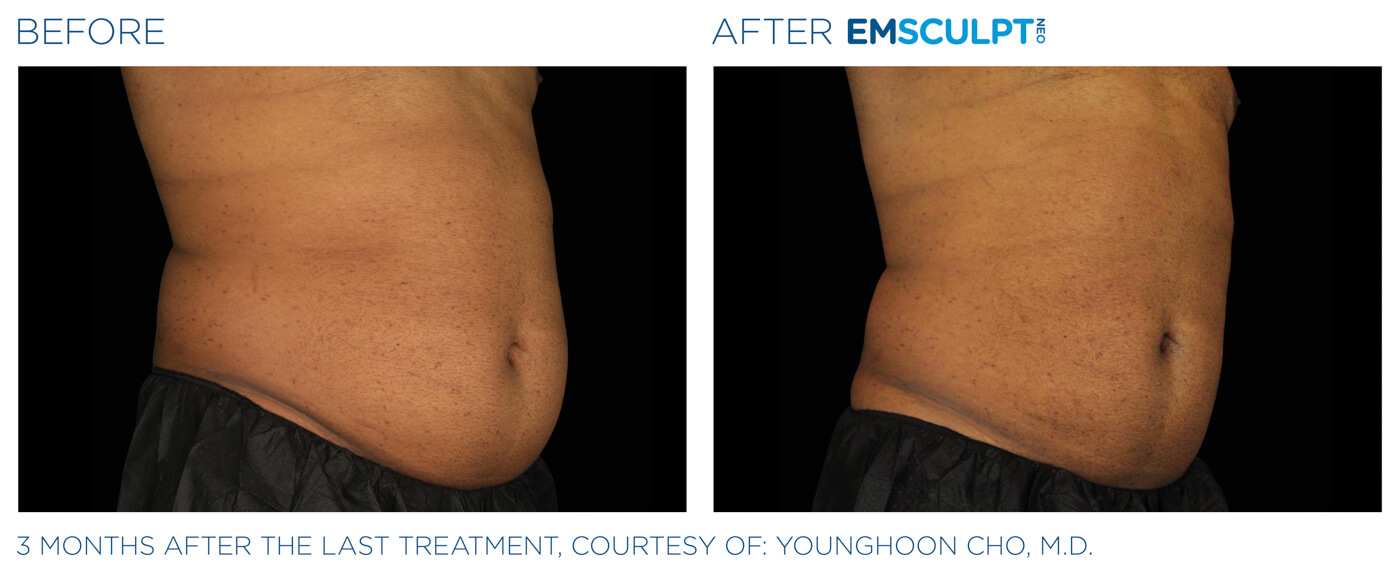 Bayou Bariatrics, Monroe, LA and Weight Loss Clinic - Emsculpt Neo Results