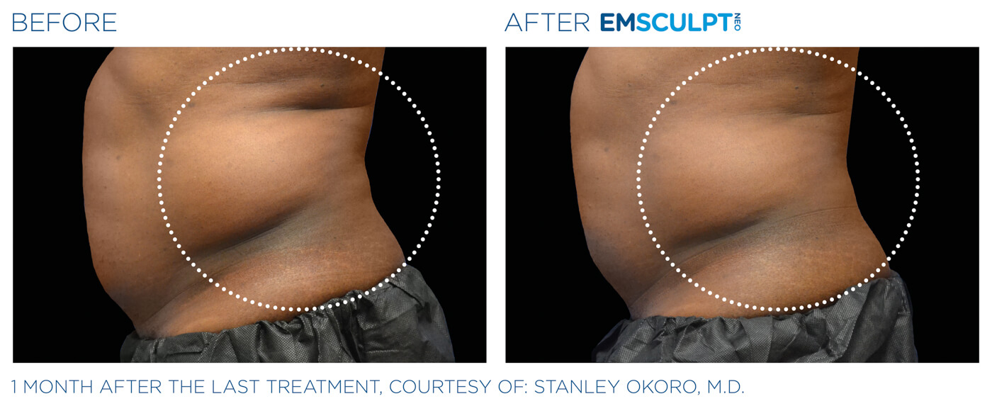 Bayou Bariatrics, Monroe, LA and Weight Loss Clinic - Emsculpt Neo Results