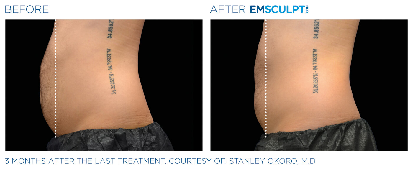 Bayou Bariatrics, Monroe, LA and Weight Loss Clinic - Emsculpt Neo Results